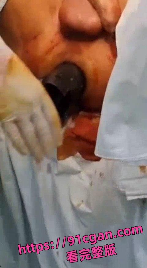 猎奇！拳头形状大玩具从屁股里拔出来的时候医生都憋不住笑了！-2